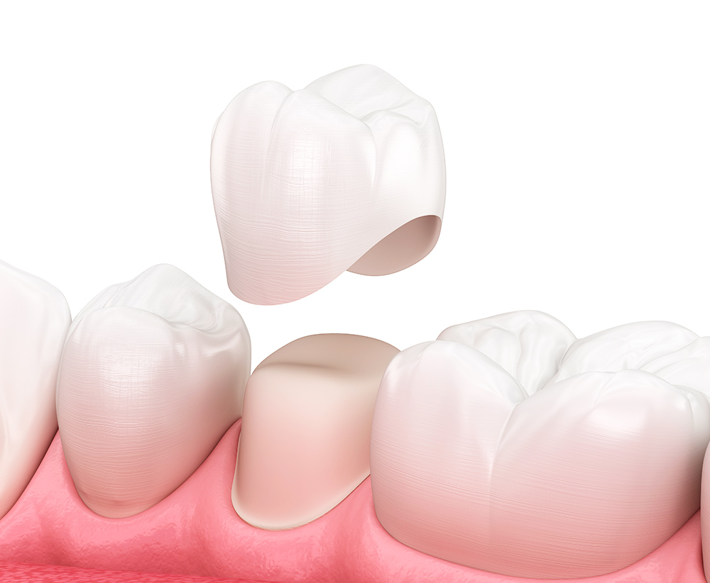 Dental Crowns in Bay Shore Brentwood Dental Care NY