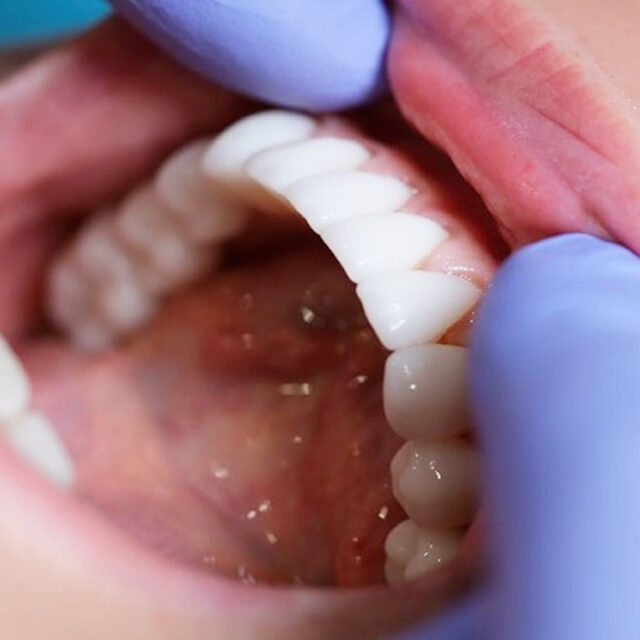 Preventative Dentistry in Bay Shore NY Brentwood Dental Care