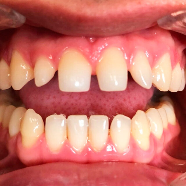 Brentwood Dental Care Restorative Dentistry in Bay Shore NY